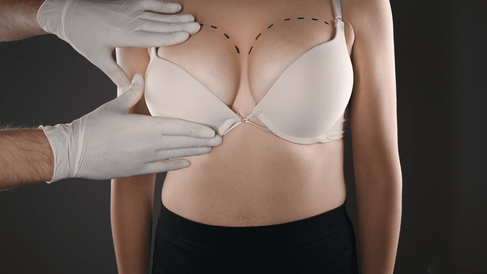 Brustvergrößerung mit Eigenfett: Bochums Führendes Zentrum für Plastische Chirurgie
